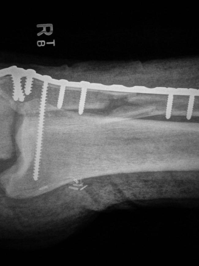 X-ray of the screws inserted