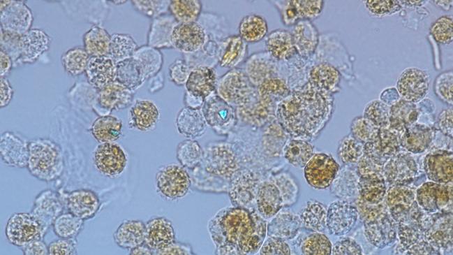 Cells taken from the lungs of a patient with silicosis, notice the speck of silica dust shining brightly.