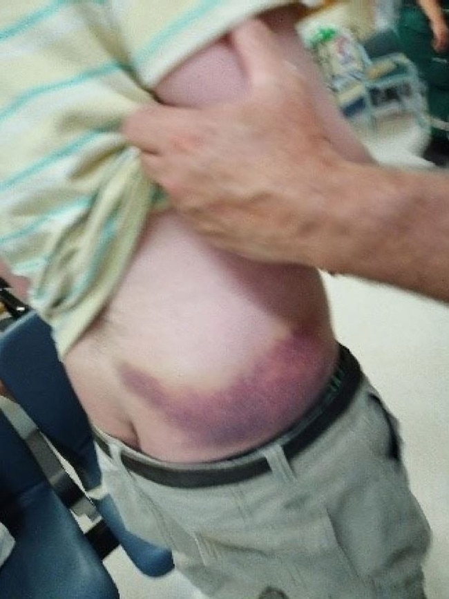 Injuries to Daniel Rogers’ torso, in a photo supplied by his mother Karen, who gave evidence at the Disability Royal Commission.