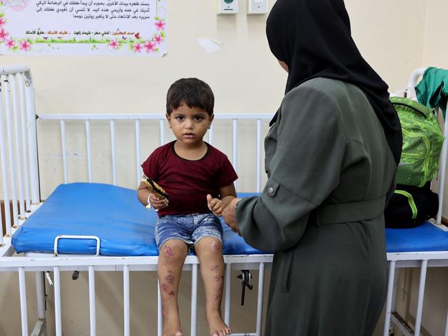 Ismail Abu Naji, aged two, receives treatment for sores that have appeared on his legs at Kamal Adwan Hospital in Beit Lahia, in the northern Gaza Strip. Picture: AFP