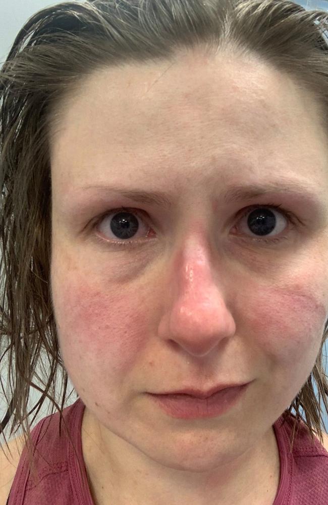 Natalie Silvey posted this picture of herself looking exhausted with a bruised face. Picture: Twitter/Natalie Silvey