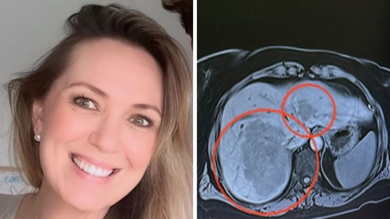 Scan shows ‘deadly’ cancer on the rise in Aus