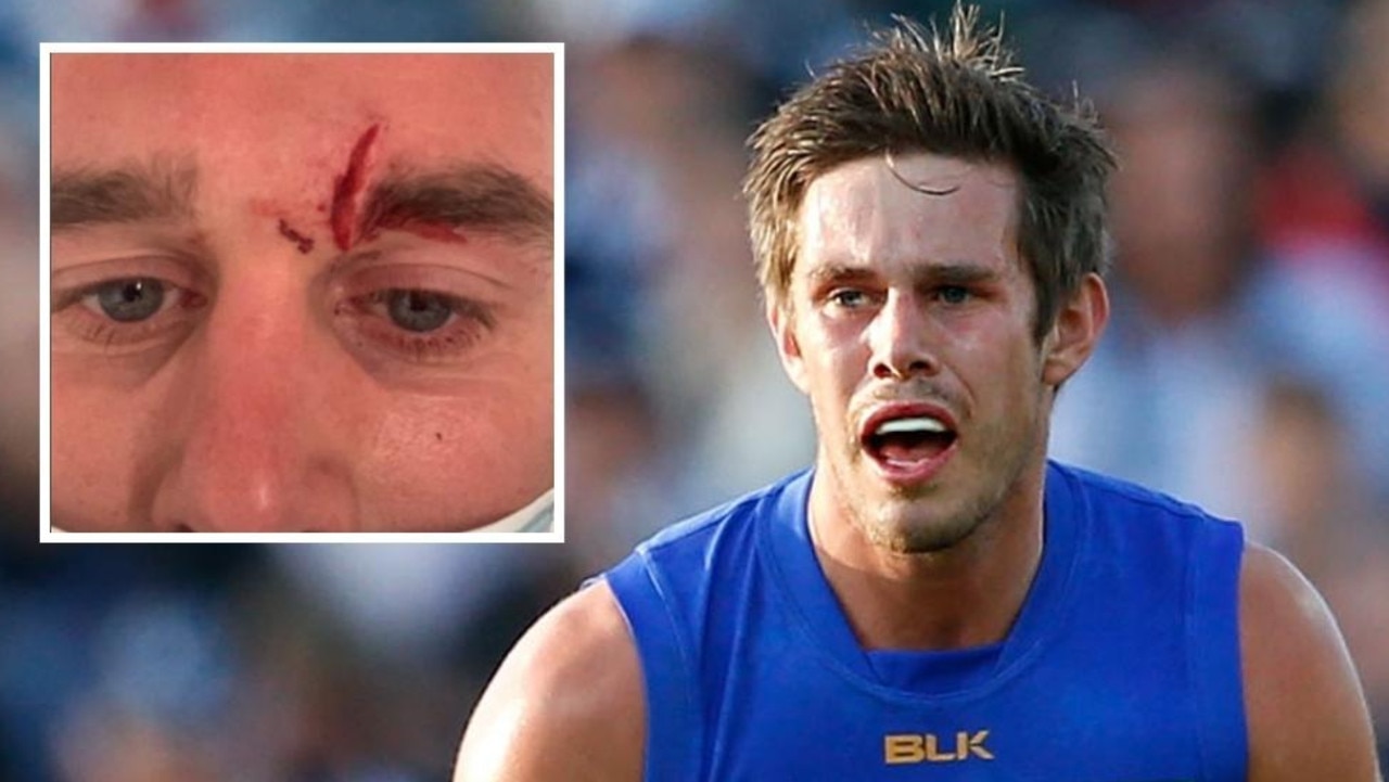 Former AFL player Ryan Bastinac has called out local footy “cowards” after suffering facial injuries in the Mornington Peninsula league on the weekend.