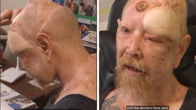 Victorian man Leigh Raaschou, who has worked outside most of his life and ‘never wore a hat’, has had almost 200 skin cancers removed.