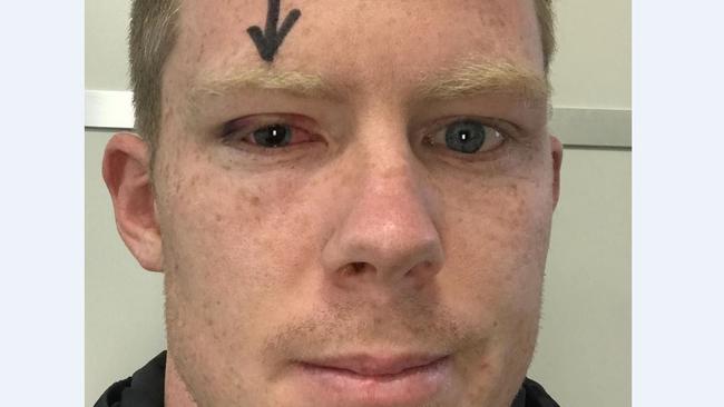 Jack Riewoldt points out his bad eye on Instagram. Picture: Instagram