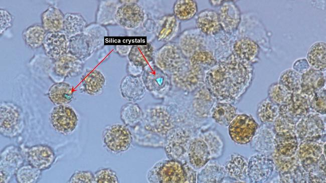 Cells taken from the lungs of a patient with silicosis, notice the speck of silica dust shining brightly. Photo: Supplied