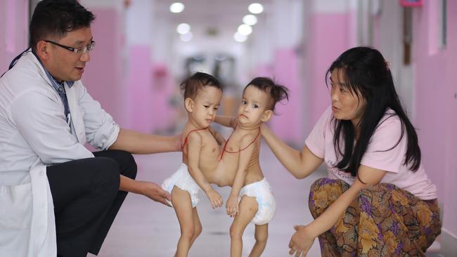 14-month-old conjoined twins Nima and Dawa are to be flown to Australia to have life saving surgery. Picture: Alex Coppel