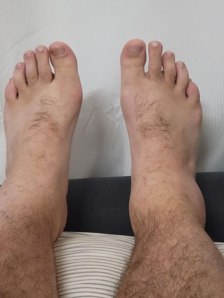 Former Tennant Creek resident Sam's ankles. Picture: Supplied.