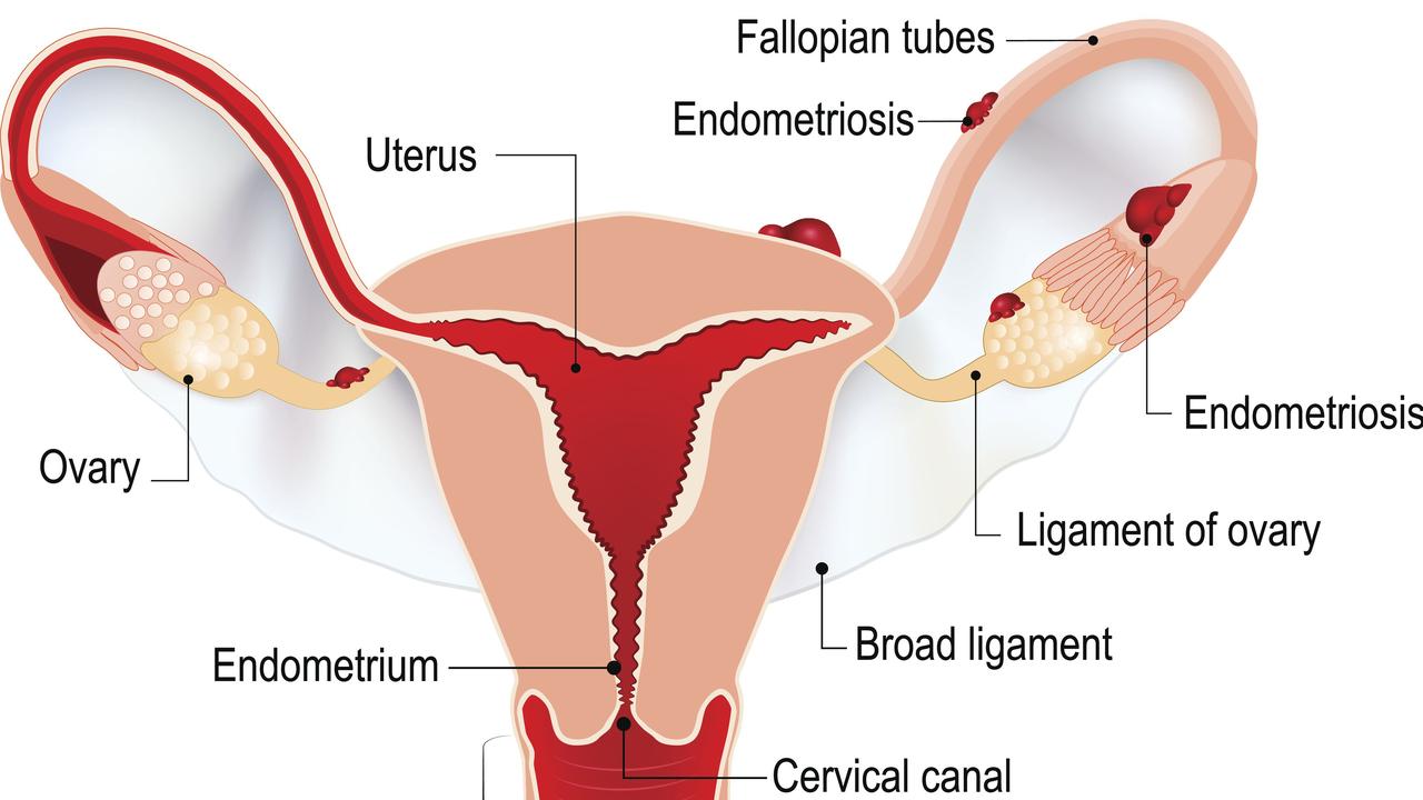 Endometriosis is a complex disease that affects the female reproductive organs.