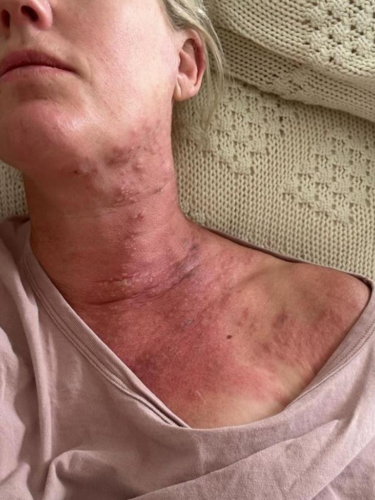 Jodie Oddy returned from a Bali holiday with shingles. Picture: Instagram