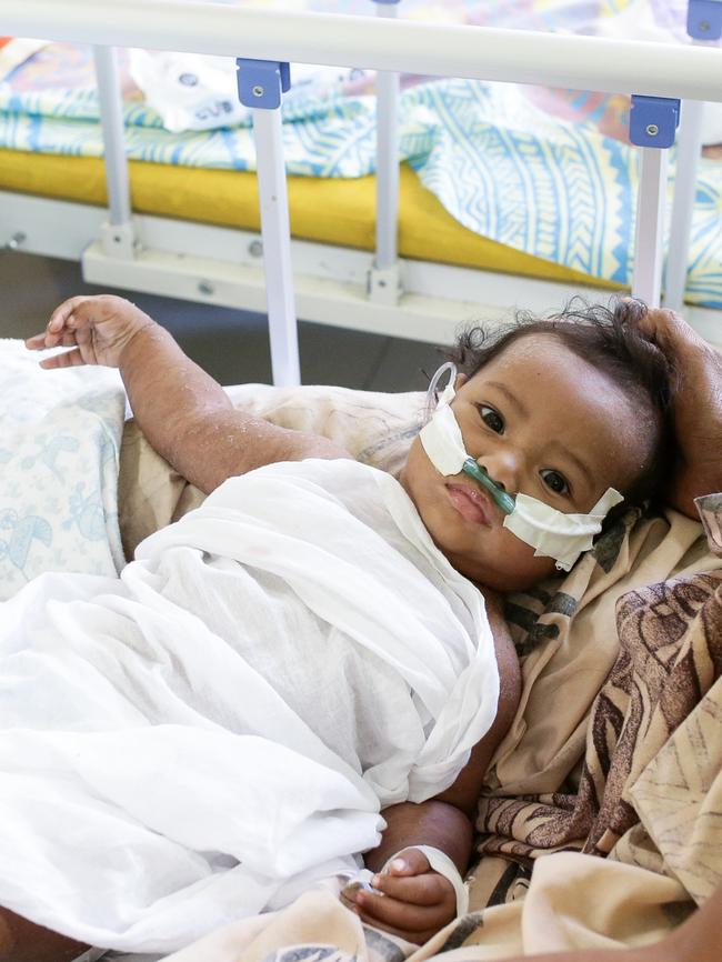 Tiresa Muliselu, 7 months, is treated for measles at Tupua Tamasese Meaole Hospital. Picture: Infinity Images Fiji