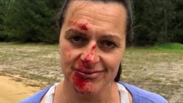 Joanna Mactier after the kangaroo attack.