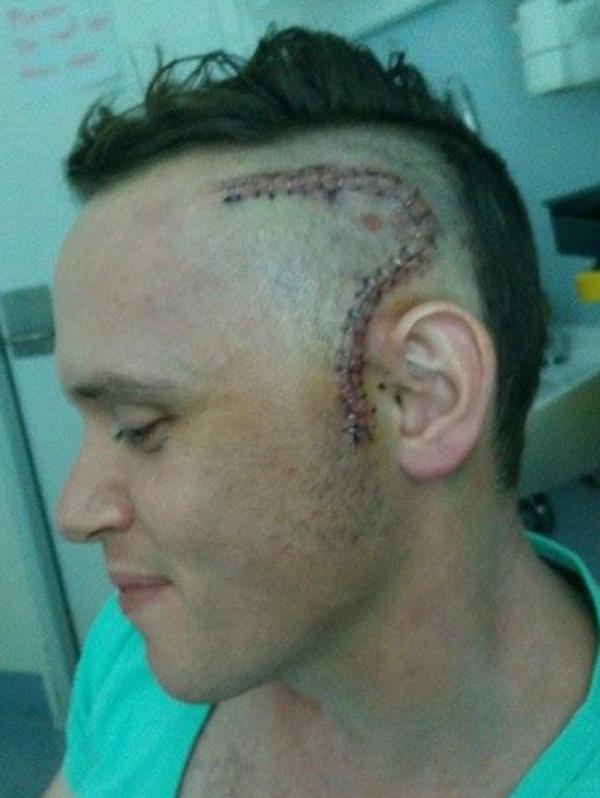 Matt Hirst after surgery to remove part of his brain tumour.