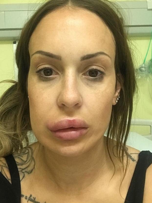 Her lips ballooned after getting the jab. Picture: The Sun