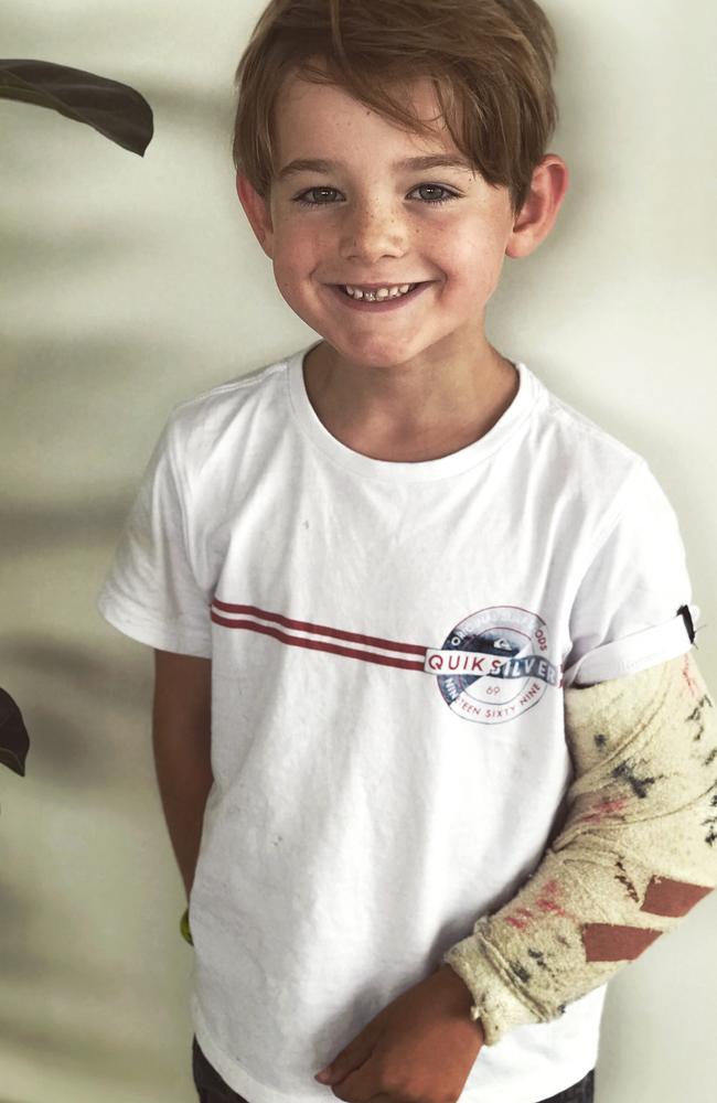 Jan Juc's Freddie Price broke his arm on his first day of prep at Bellbrae Primary School. Picture: Supplied.