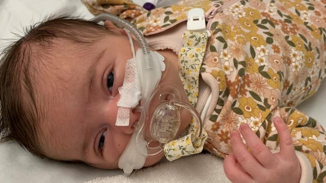 Toowoomba toddler Annabelle Peacock, 1, was diagnosed with laryngomalacia at three weeks old, that caused soft tissue to fall over and block her airway.