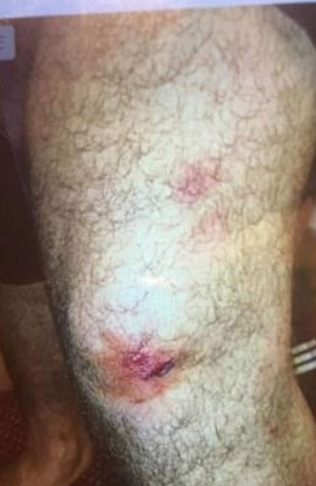 This photo supplied to Melbourne’s 3AW shows injuries sustained by a passenger on board the Carnival Legend. Picture: 3AW