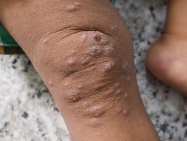 Mpox causes painful sores on the skin.