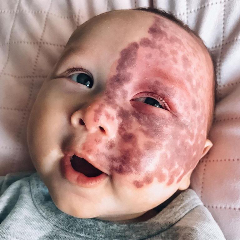 Kingsley was born with a massive birthmark on his face. Picture: Instagram