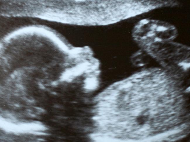 Baby ultrasound sonogram. Picture: istock