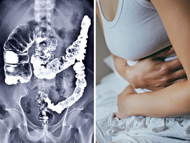 Woman, 44, with stage 3 bowel cancer reveals symptoms she ‘ignored’. Picture: iStock