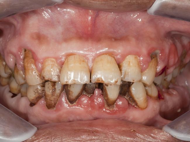 Heavy calculus deposits, gum swelling, chronic inflammation, gingival recession and stains.