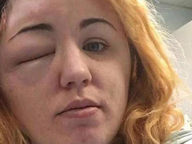 Kirsty's eye began to swell and she went into hospital, where she was treated for an allergic reaction. Picture: PA/Real Life