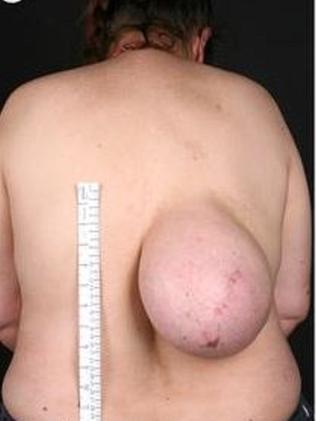 BREKKIE WRAP: Dublin woman grows massive 'breast' on back