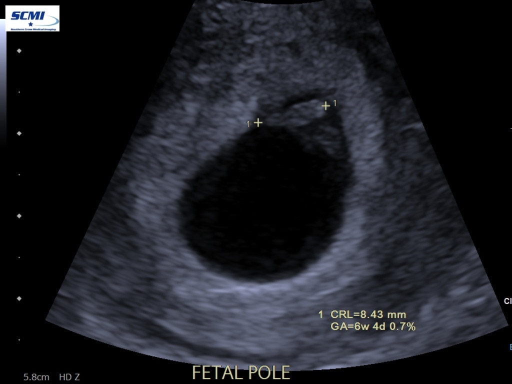 Six week dating scan – The white blob between the two points is the fetal pole (embryo).