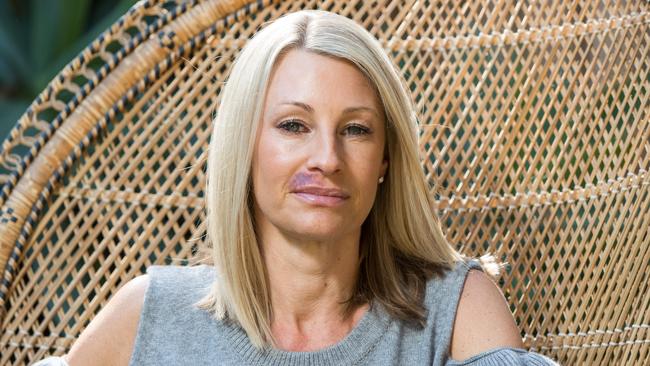 Kristine McCarthy, who was left with huge swelling and bruising to her lips after she had lip fillers. (Pic: AAP/Julian Andrews).