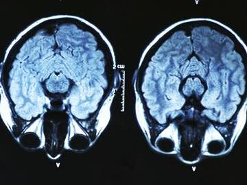 MRI Brain Scan