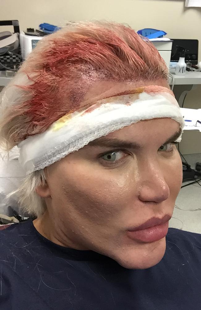 The hairline surgery means he will have a feminine features. Picture: Rodrigo Alves/Caters News