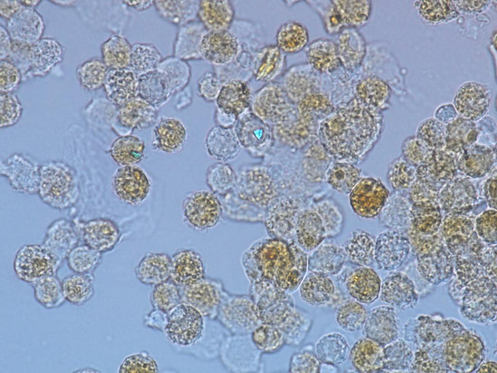 Cells taken from the lungs of a patient with silicosis, notice the speck of silica dust shining brightly