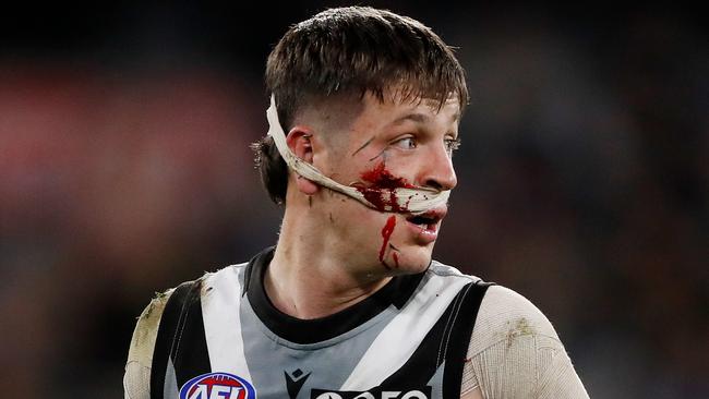 Zak Butters shows the effects of his head clash with captain Tom Jonas on Thursday night. Picture: Getty Images