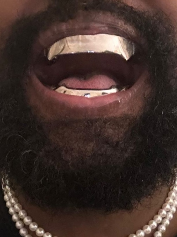 Kanye West has seemingly had his teeth removed and replaced with titanium.