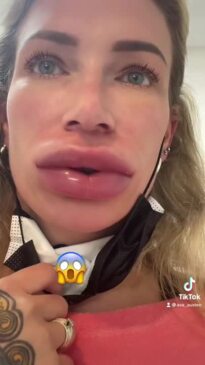 Woman's hilarious lip filler disaster