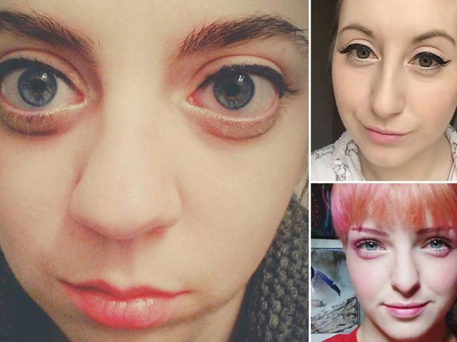 Bizarre trend has girls injecting their eyes