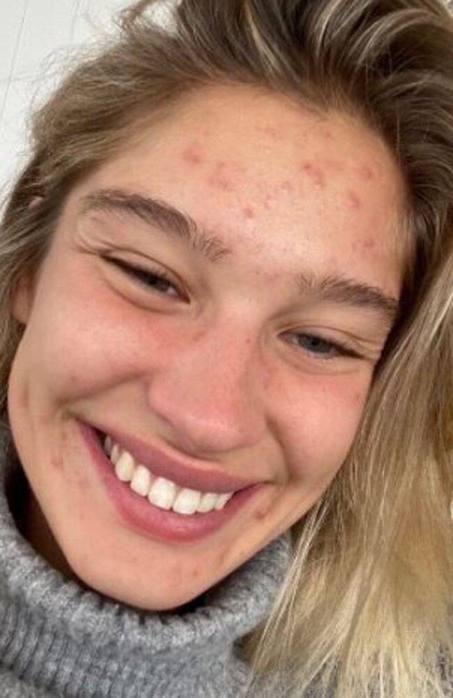 But her acne returned and worsened at the start of this year, forcing the Sydney model to stop work. Picture: Instagram/Harmonyabell