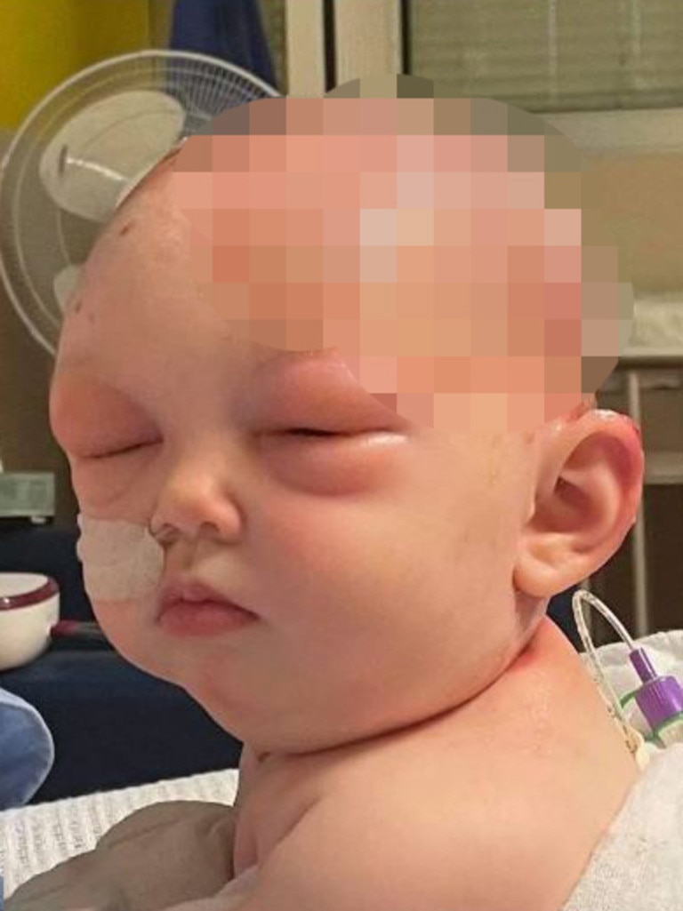 Sienna suffered horror burns and her face swelled up, temporarily blinding her. Picture: Supplied