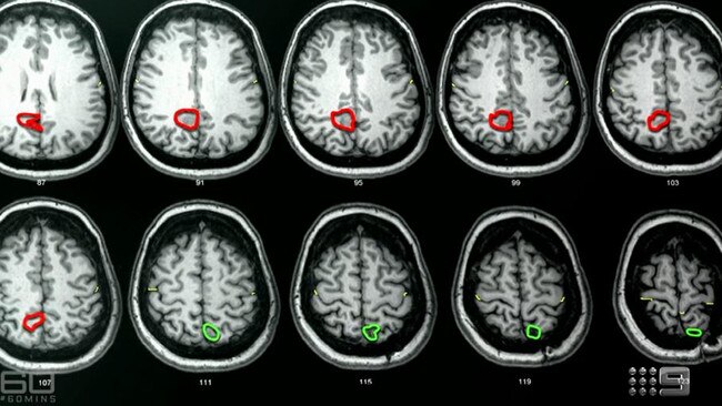 The scans, shown by 60 Minutes, show the location of the tumour circled in red and the location of the first operation in green. Picture: 60 Minutes