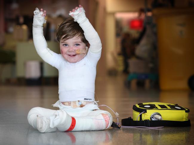 It takes 45 minutes to change Jacob’s nappy because of his head-to-toe bandages. Picture: David Caird