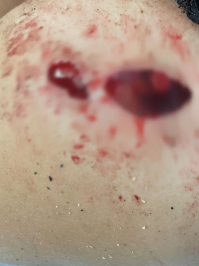 Sommer Kubank's wound