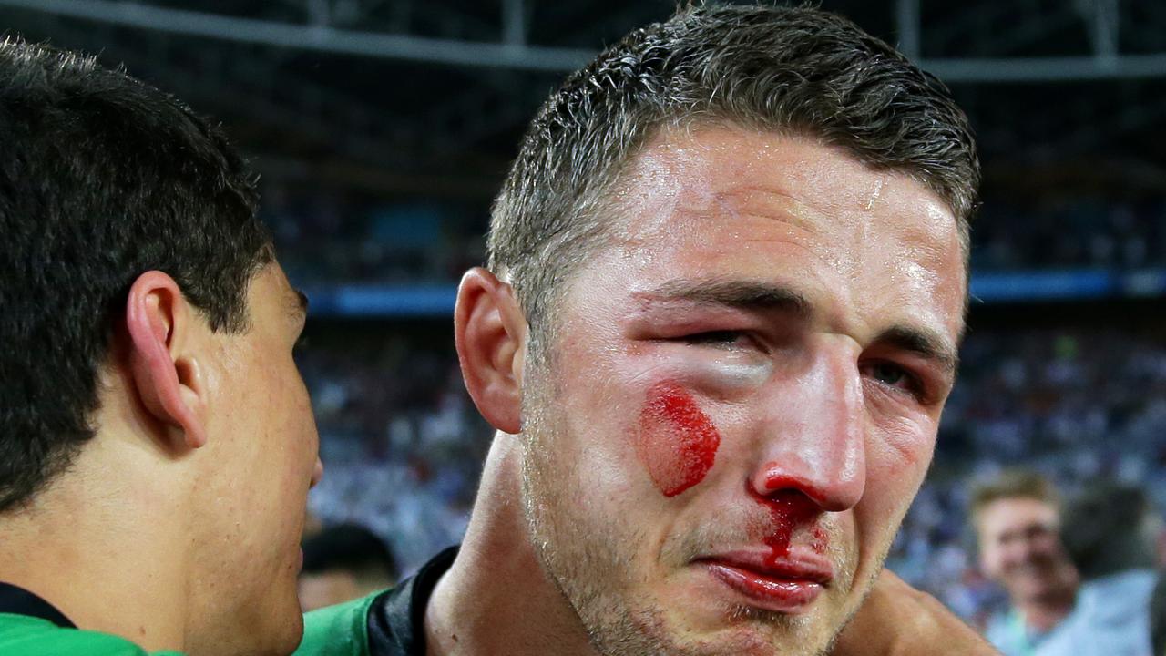 Sam Burgess face was a mess when he finished the game. Picture Gregg Porteous