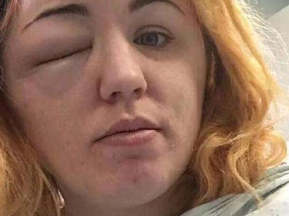 Kirsty's eye began to swell and she went into hospital, where she was treated for an allergic reaction. Picture: PA/Real Life