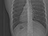 Horror effect of endless rain shows on X-ray