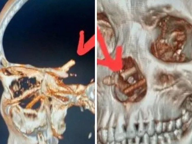 X-ray reveals the reason man had a headache for five months