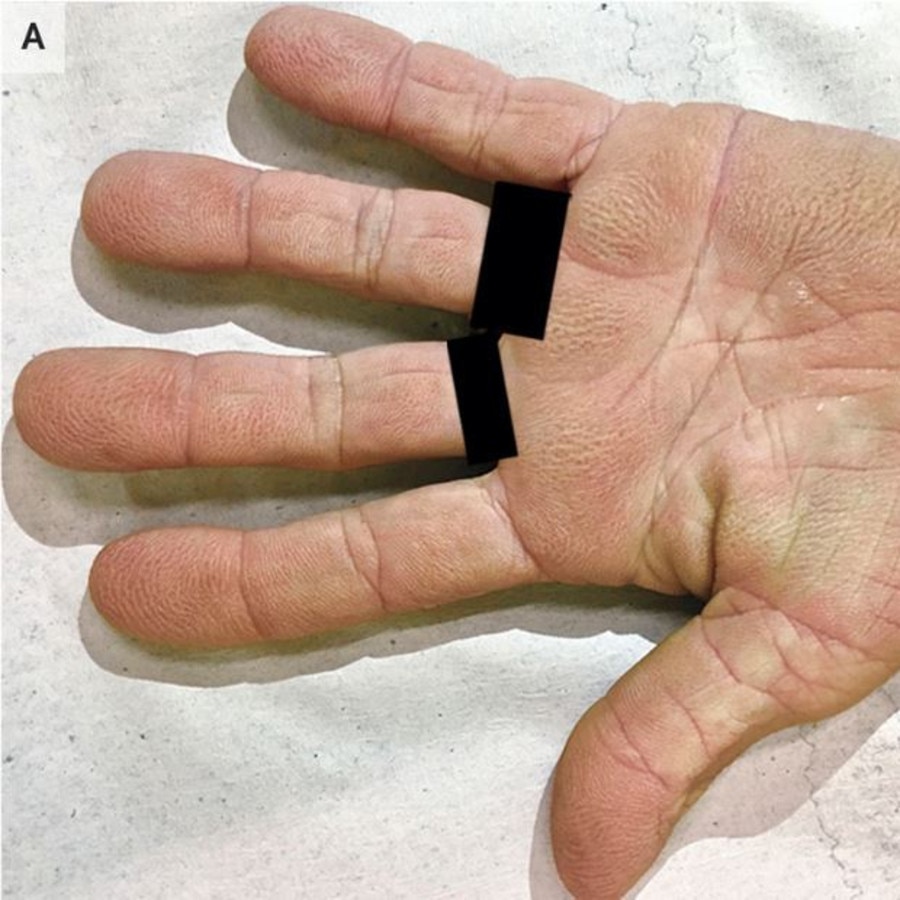 Woman's bizarre hand rash was rare warning sign of cancer | news.com.au — leading news site