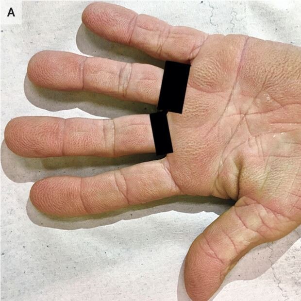 The 73-year-old woman went to see a doctor after she broke out in these strange marks on her hands. They were diagnosed as tripe palms. Picture: The New England Journal of Medicine