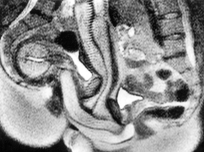 The scan showed ‘the penis has the shape of a boomerang’. Picture: BMJ