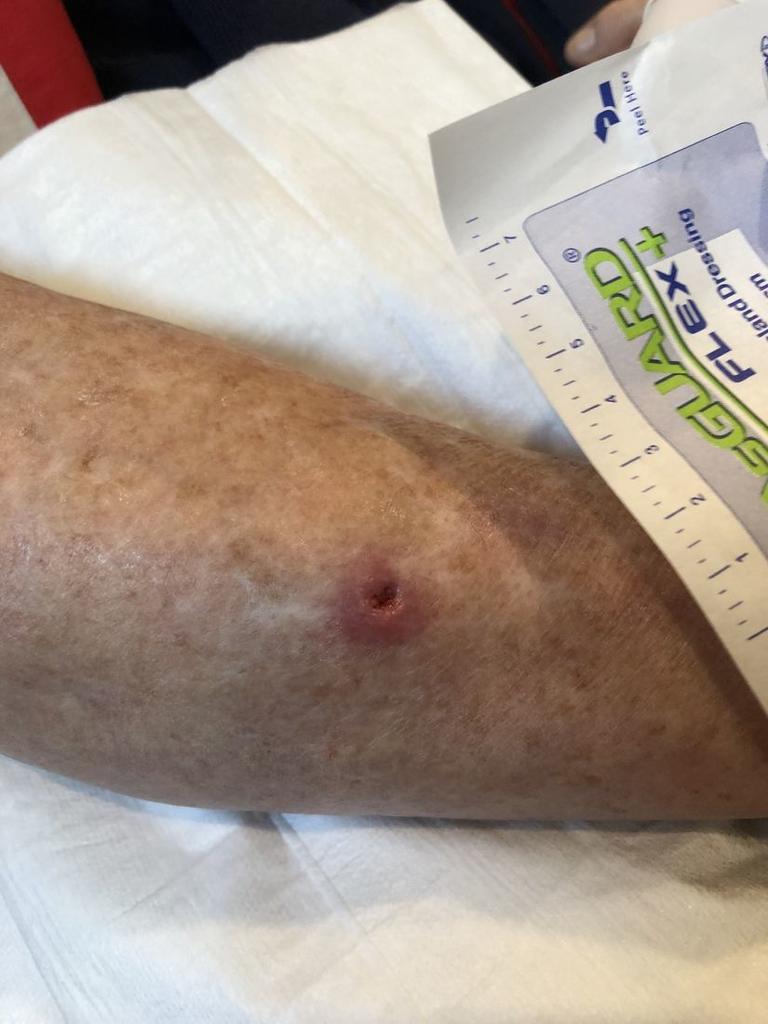 Small ulcers can usually be treated with antibiotics and heal within six months. Picture: South Coast Medical.